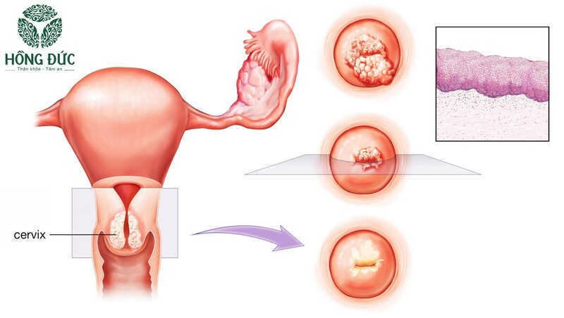 5+ cách chữa viêm lộ tuyến cổ tử cung bằng thảo dược hiệu quả
