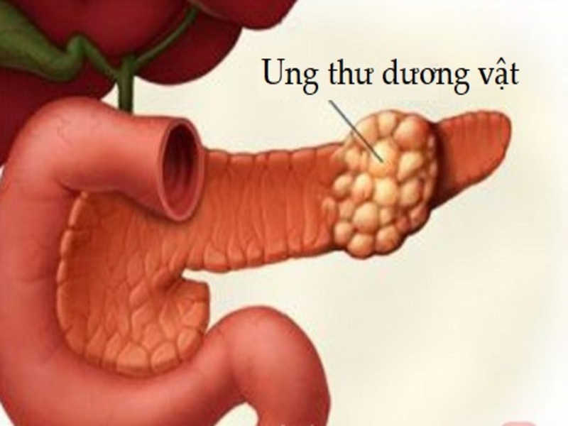 Dương vật bị ung thư