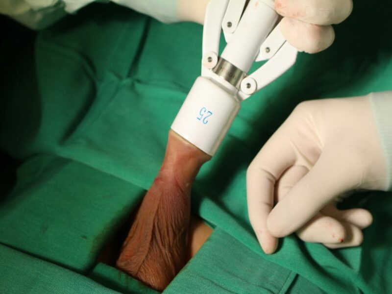 Hình 4: Phương pháp cắt bao quy đầu bằng máy Surkon không gây đau đớn