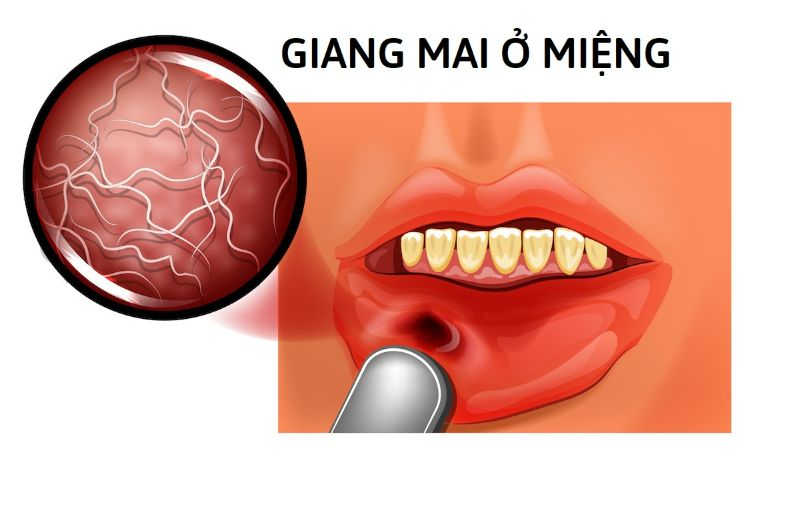 Người bệnh có nhiều biểu hiện sau khi mắc phải giang mai ở vùng miệng