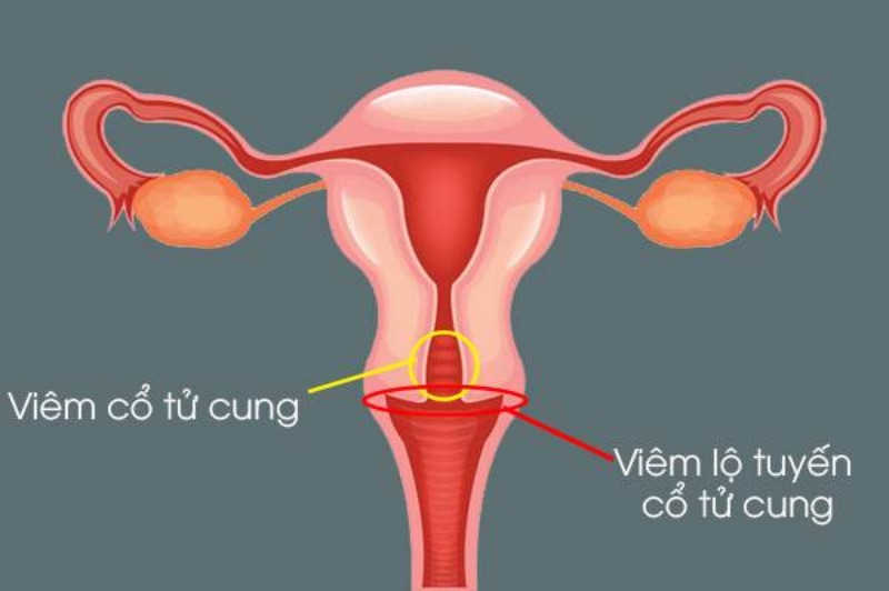 Viêm lộ tuyến cổ tử cung là một dạng tổn thương lành tính thường gặp ở các chị em phụ nữ