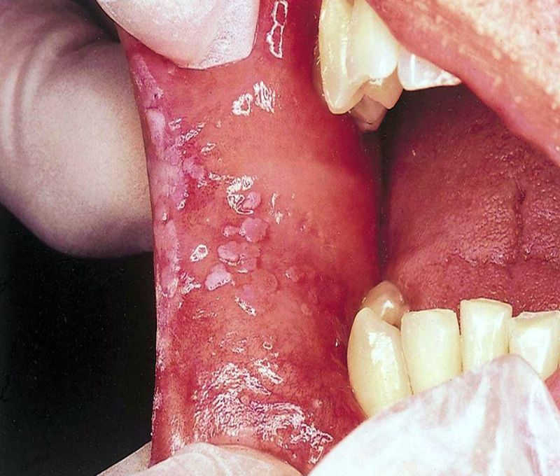Nắm được các triệu chứng lậu ở miệng sẽ giúp việc điều trị tốt hơn