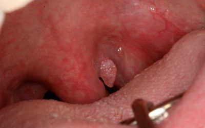Nguyên nhân và dấu hiệu của bệnh sùi mào gà ở cổ họng