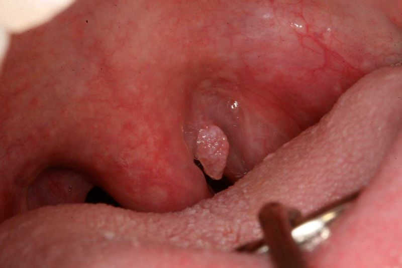Nguyên nhân và dấu hiệu của bệnh sùi mào gà ở cổ họng