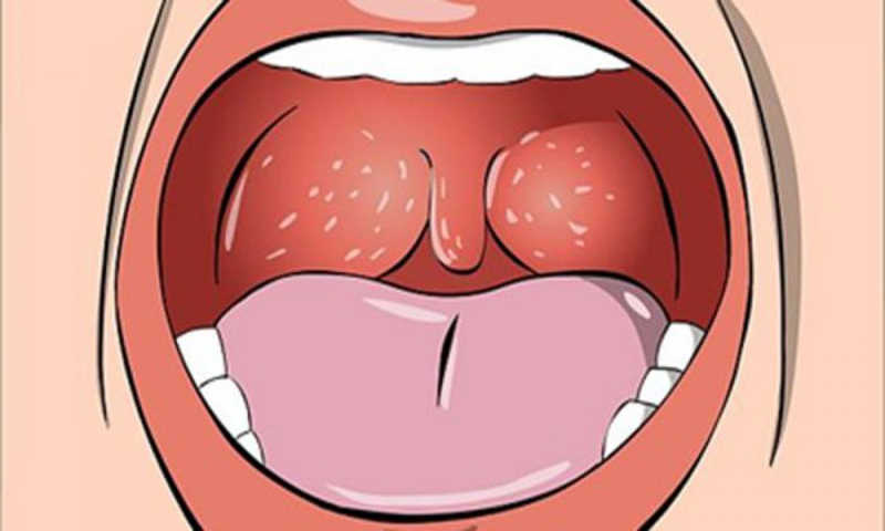 triệu chứng bệnh lậu ở cổ họng