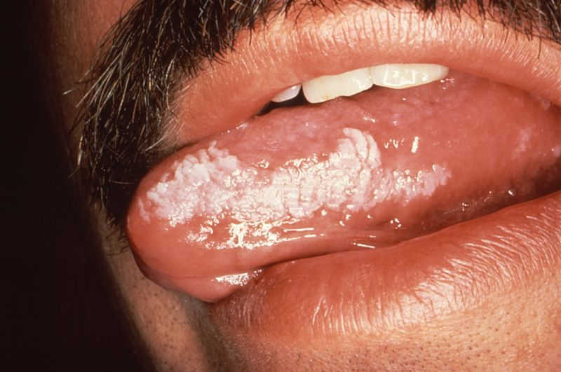 Phát hiện sớm các triệu chứng của bệnh lậu ở miệng việc điều trị sẽ dễ dàng hơn