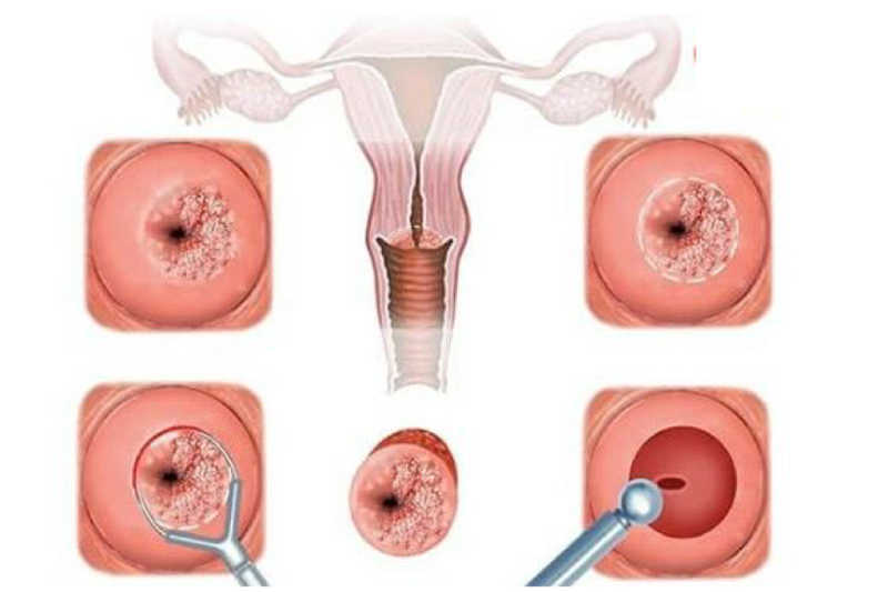 Viêm lộ tuyến cổ tử cung được chia thành ba giai đoạn