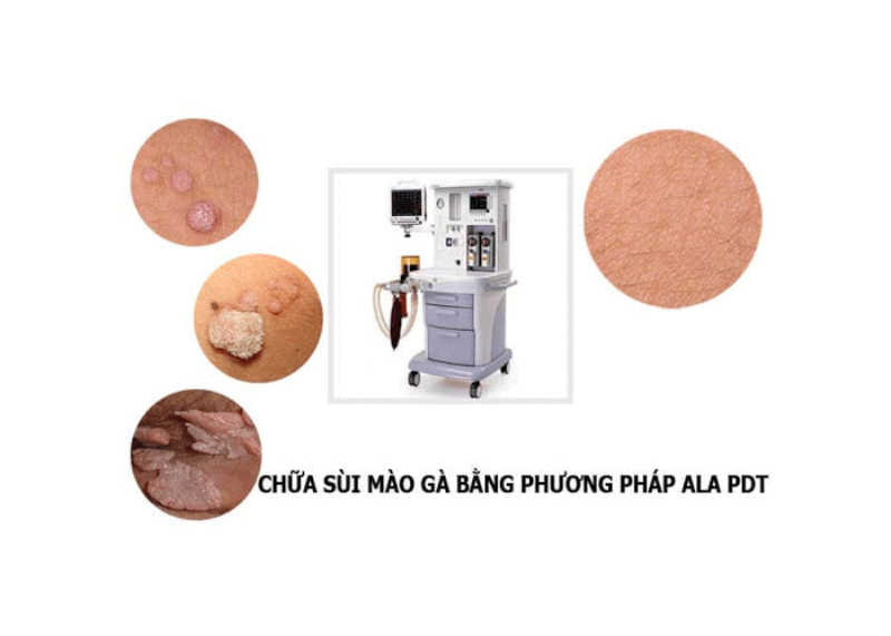 Công nghệ ALA – PDT hiện đại điều trị hiệu quả sùi mào gà. 