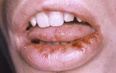 Cần làm gì khi có dấu hiệu bệnh giang mai ở miệng?