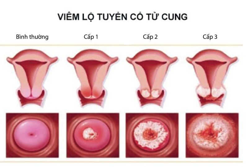 Hình ảnh viêm lộ tuyến cổ tử cung từng giai đoạn bạn cần biết