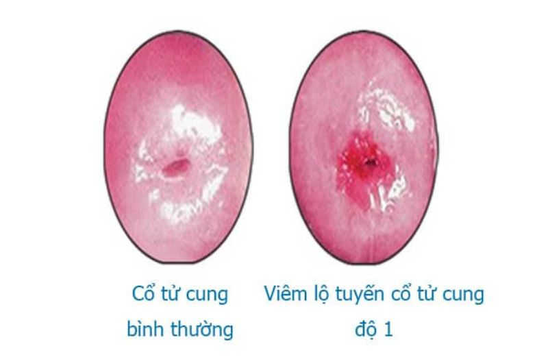 Hình ảnh viêm lộ tuyến cổ tử cung giai đoạn 1