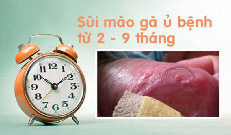 Thời gian ủ bệnh sùi mào gà thông thường từ 2 tới 9 tháng