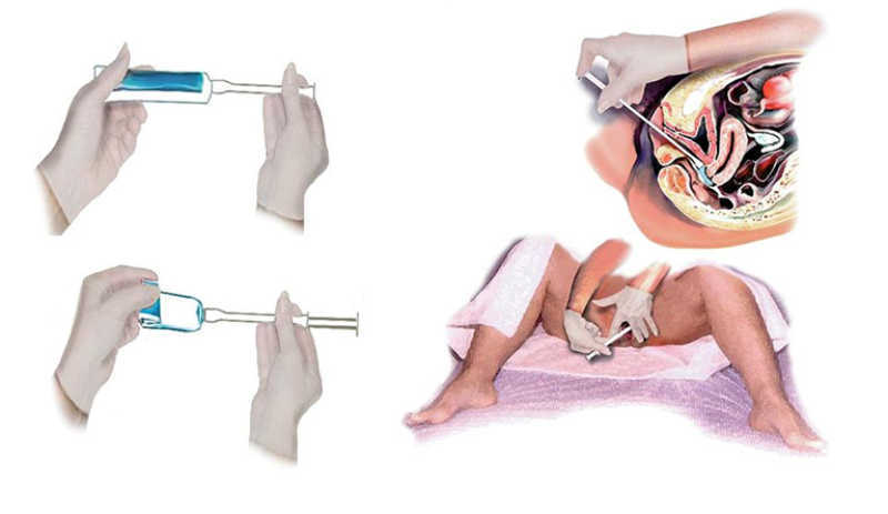 Cách đặt thuốc Gynophilus đúng cách để đạt được hiệu quả tốt nhất.