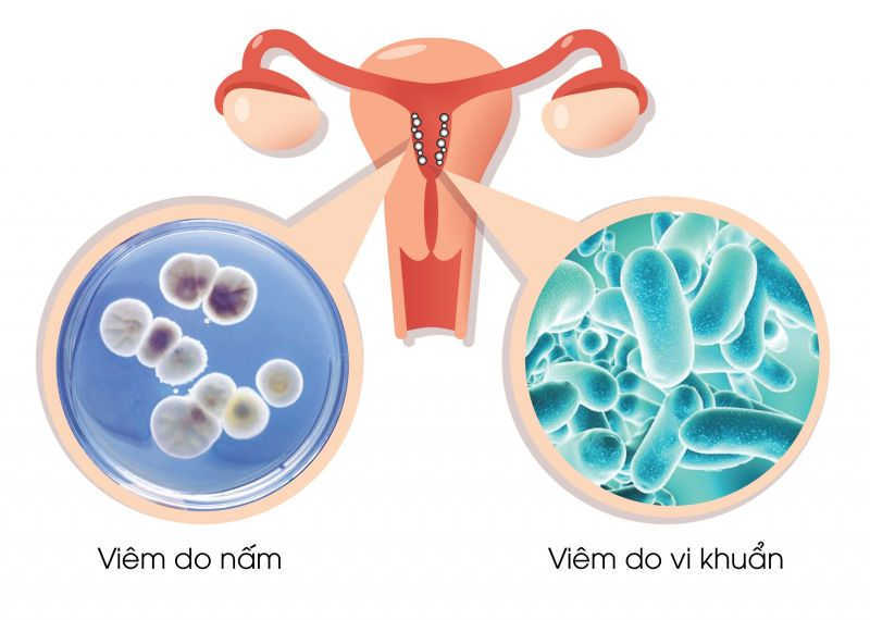 Viêm nhiễm phụ khoa ở phụ nữ mang bầu có thể xuất hiện các triệu chứng ngứa, đau rát...