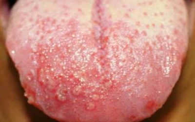 Mụn rộp sinh dục lưỡi: Triệu chứng và cách điều trị hiệu quả