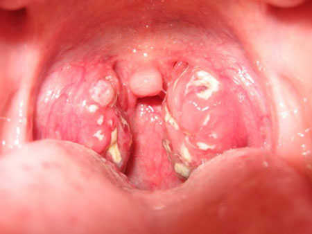 Triệu chứng bệnh mụn rộp sinh dục ở lưỡi