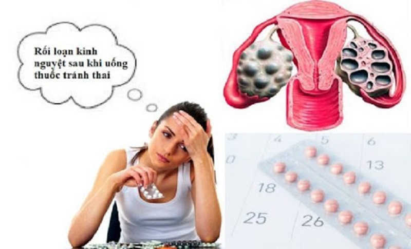 rối loạn kinh nguyệt sau khi uống thuốc tránh thai