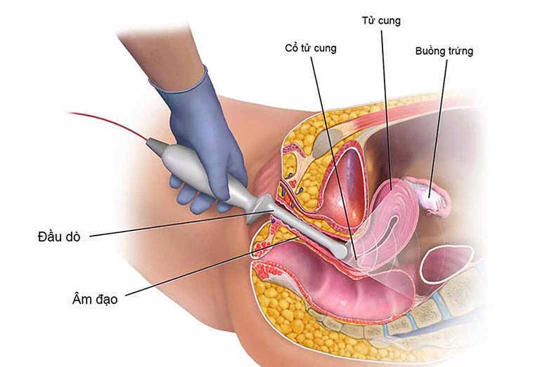 Chụp XQuang tử cung và vòi trứng  Bệnh Viện FV