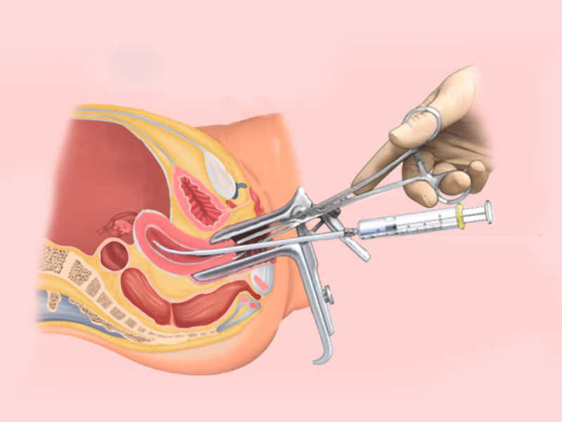 Kỹ thuật IUI - Bơm tinh trùng vào tử cung phụ nữ