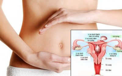 [Tổng hợp] 7+ nguyên nhân gây u xơ tử cung & cách phòng ngừa hiệu quả