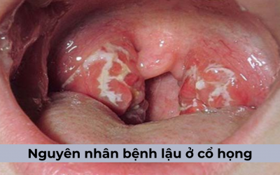 [Tổng hợp] 4 Nguyên nhân bệnh lậu ở cổ họng và cách điều trị hiệu quả