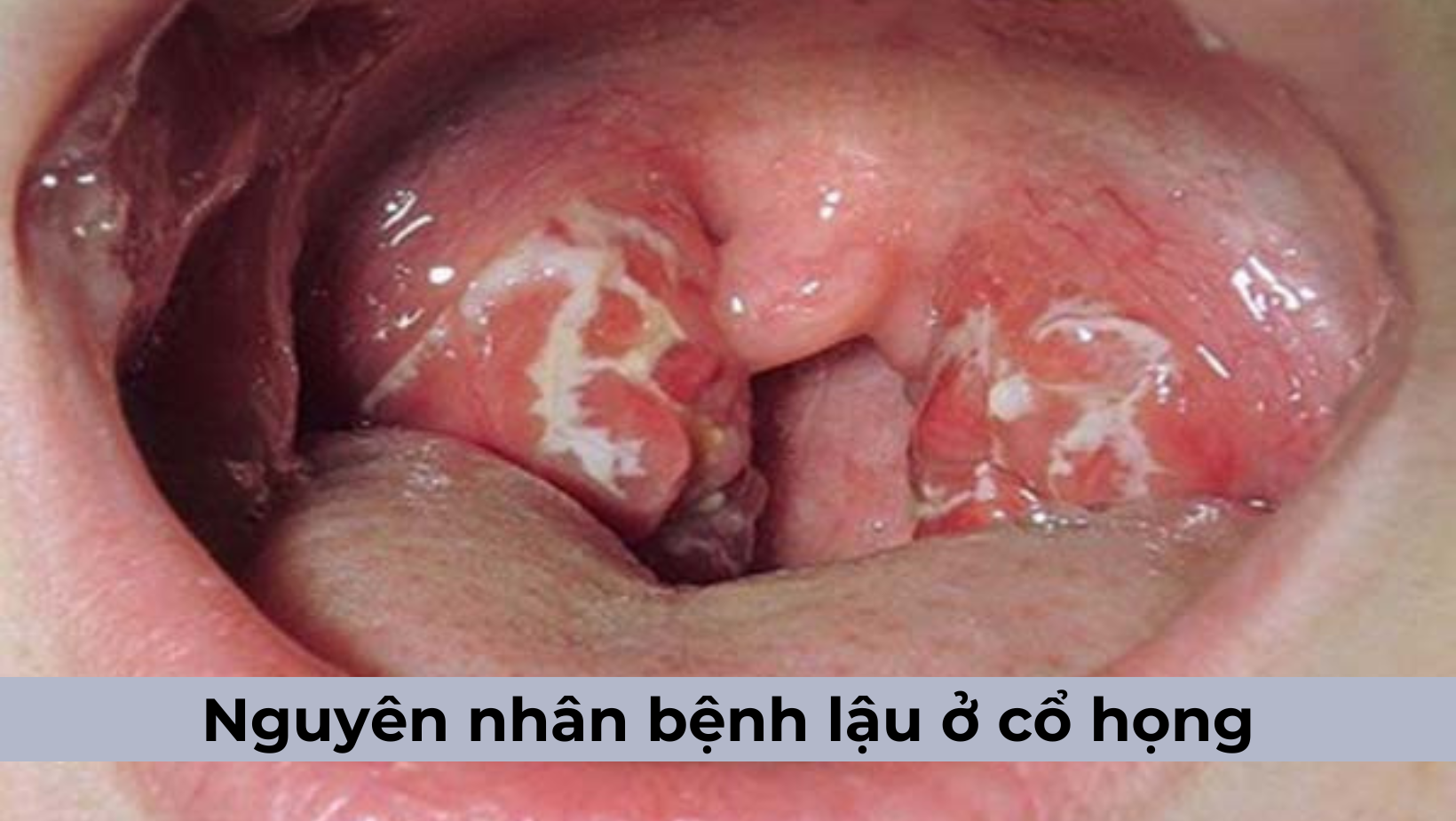 Nguyên nhân bệnh lậu ở cổ họng