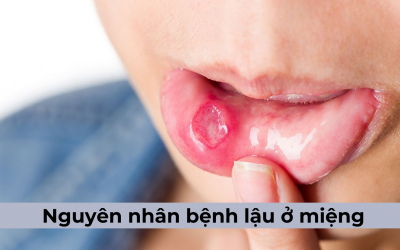 Nguyên nhân bệnh lậu ở miệng và vấn đề khác liên quan tới bệnh lậu