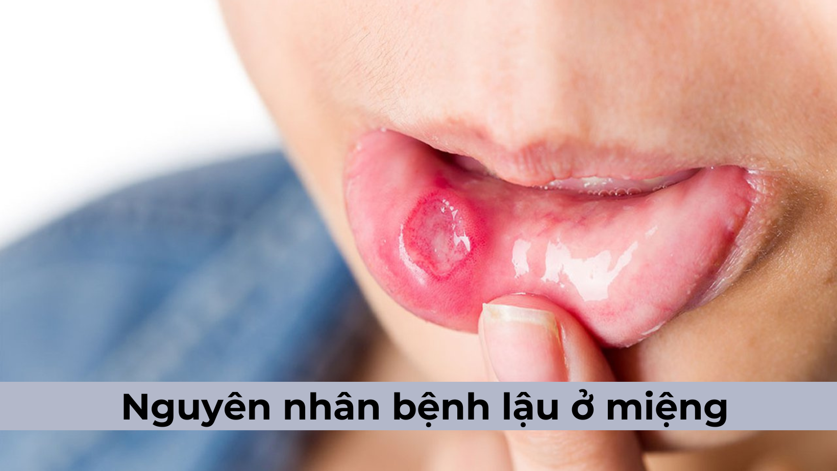 Nguyên nhân bệnh lậu ở miệng