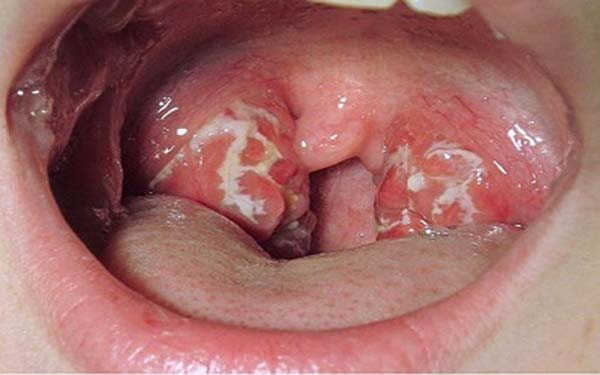 Cách chữa bệnh lậu ở cổ họng