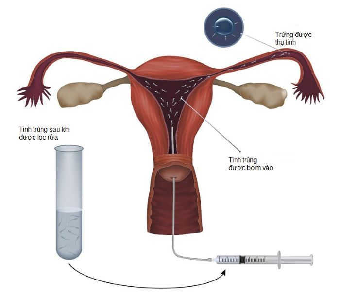 Phương pháp bơm tinh trùng có hiệu quả?