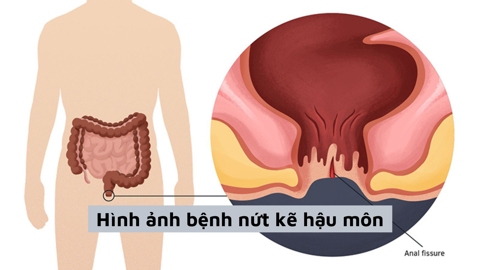 Hình ảnh bệnh nứt kẽ hậu môn