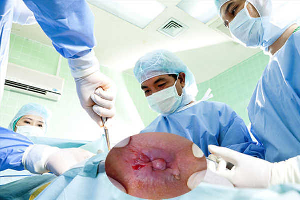 Biến chứng nguy hiểm có thể gặp hậu phẫu thuật cắt trĩ