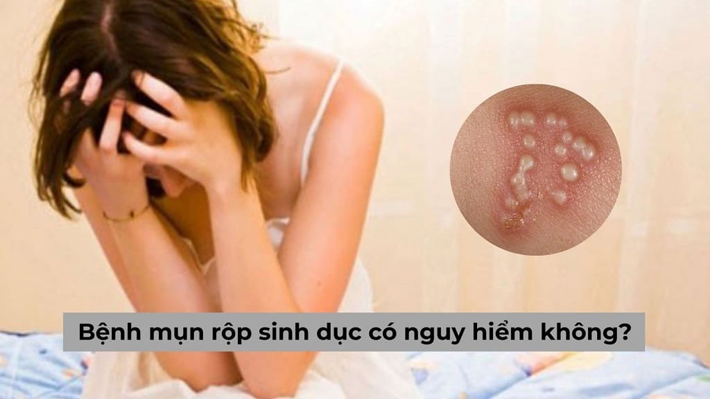 Bệnh mụn rộp sinh dục có nguy hiểm không