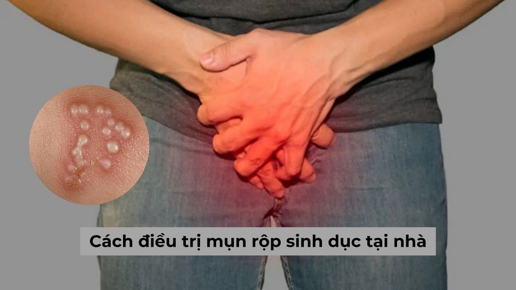 Cách điều trị mụn rộp sinh dục tại nhà