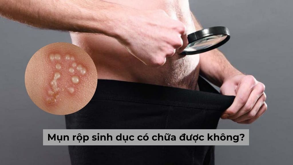 Mụn rộp sinh dục có chữa được không