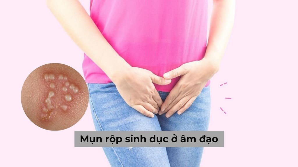 Mụn rộp sinh dục ở âm đạo