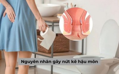 Nguyên nhân gây nứt kẽ hậu môn và cách khắc phục là gì? 