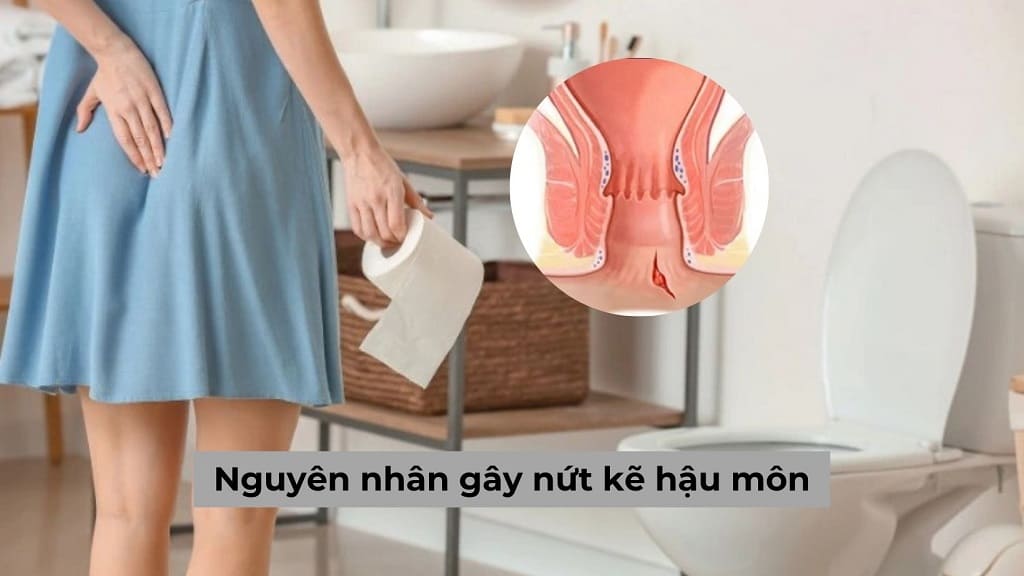 Nguyên nhân gây nứt kẽ hậu môn