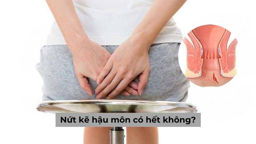 Nứt kẽ hậu môn có hết không?