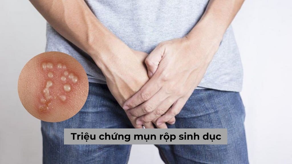 Triệu chứng mụn rộp sinh dục