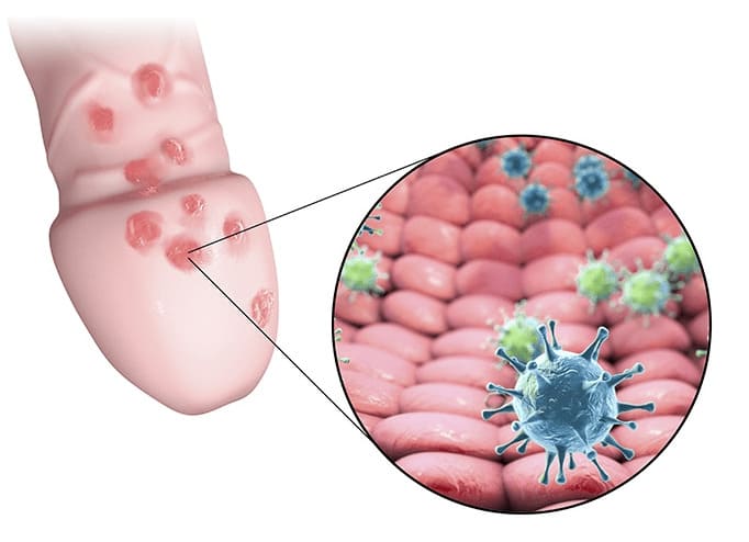 Mụn rộp sinh dục là gì?