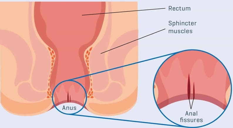 Bệnh nứt kẽ hậu môn có hết không?