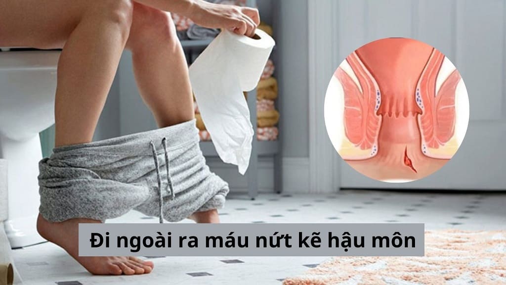 Đi ngoài ra máu nứt kẽ hậu môn