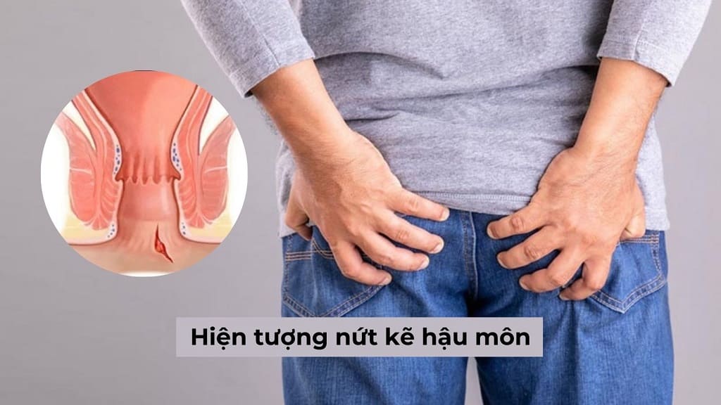 Hiện tượng nứt kẽ hậu môn