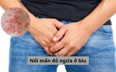 Nổi mẩn đỏ ngứa ở bìu: Cảnh báo nguy hiểm tiềm ẩn bạn cần biết