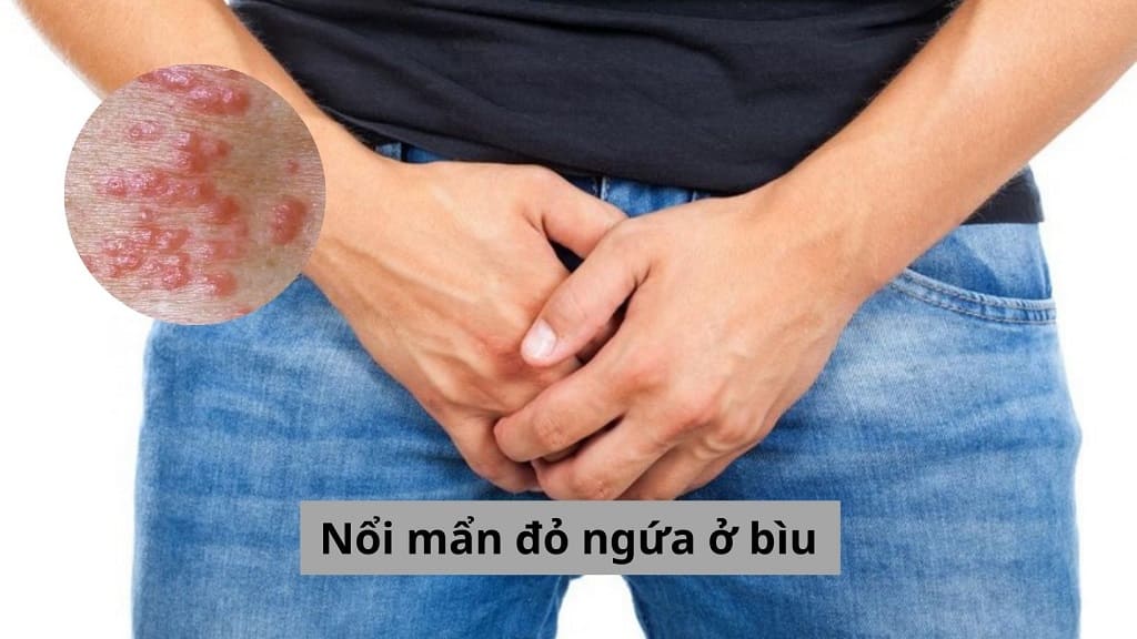 Nổi mẩn đỏ ngứa ở bìu