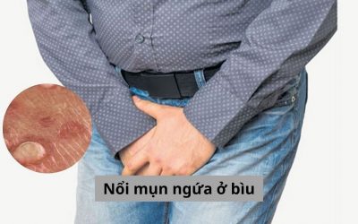 Nổi mụn ngứa ở bìu: Nguyên nhân và cách điều trị