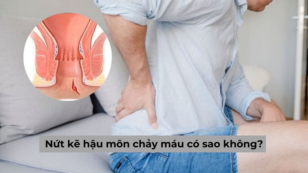 Nứt kẽ hậu môn chảy máu có sao không