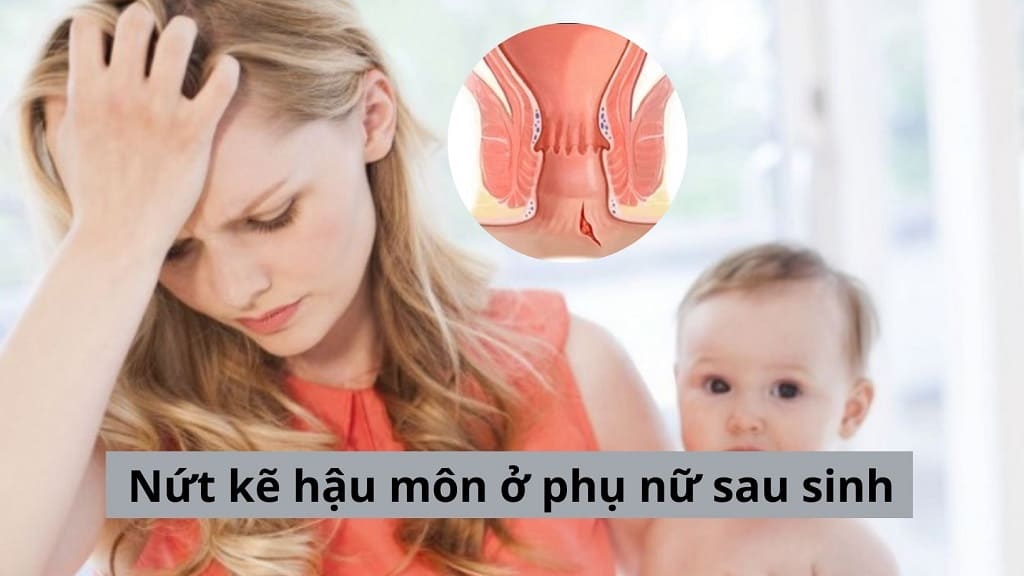 Nứt kẽ hậu môn ở phụ nữ sau sinh