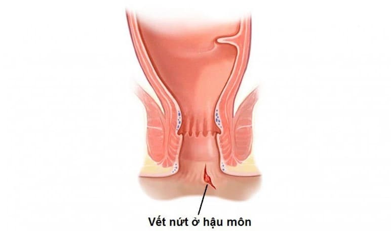 Bệnh nứt kẽ hậu môn